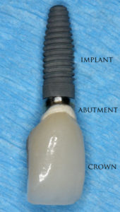 Dental implant - Diagram of a dental implant