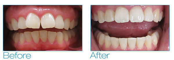 Kincardine Dentistry - Invisalign - Straighten Teeth At Any Age Kincardine  Dentistry