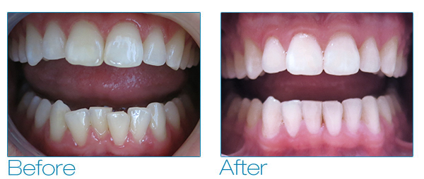 Invisalign® - Thornhill, Vaughan, Richmond Hill - Clear Removable Aligners